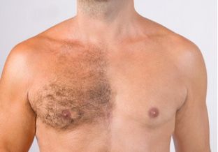 Epilation du torse chez les hommes