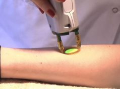 Enquête sur l’épilation définitive au laser et à la lumière pulsée épilation au laser sur l'avant-bras