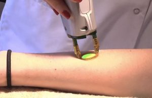 Enquête sur l’épilation définitive au laser et à la lumière pulsée épilation au laser sur l'avant-bras