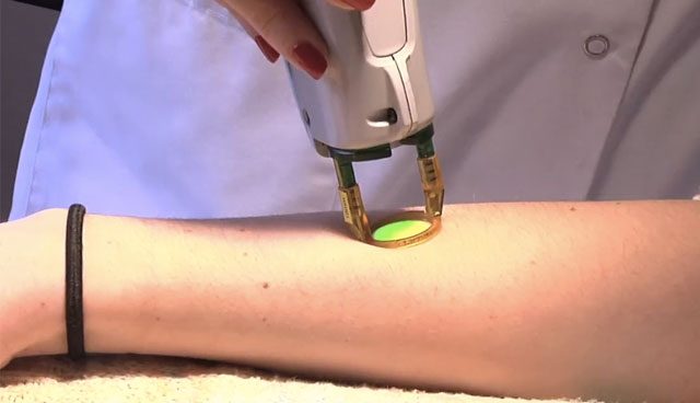 épilation au laser sur l'avant-bras