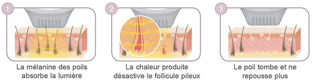 fonctionnement de la lumière pulsée