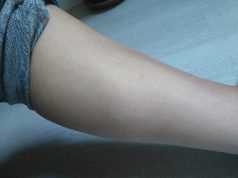 La lumière pulsée, j’ai testé, je vous raconte ! mollet après lumière pulsée